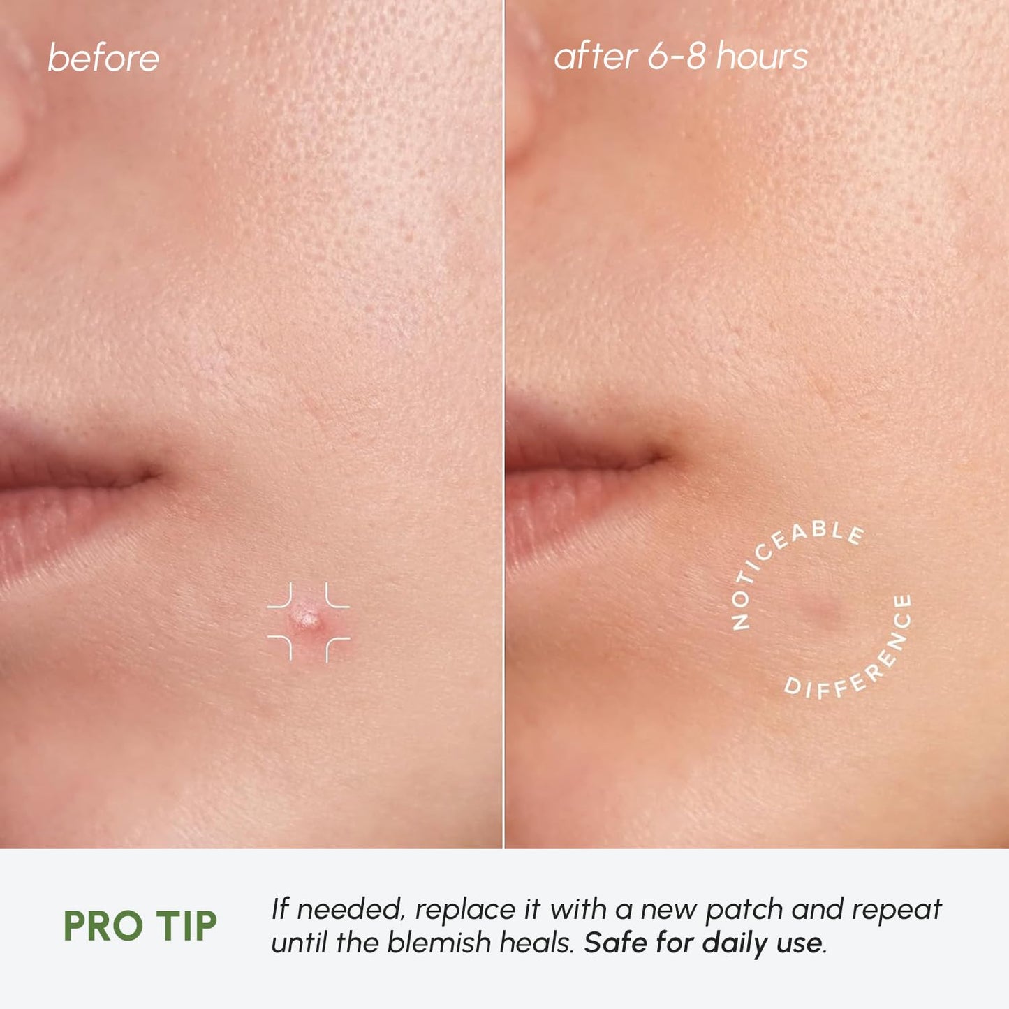 MAREE Pimple Patches for Face - Acne Clearing Device - Clear Acne Patches for Face - Invisible Hydrocolloid Patch Parches Para Acne Stickers Zit Dots - Cystic Zit Healing Blemish Pinple Covers